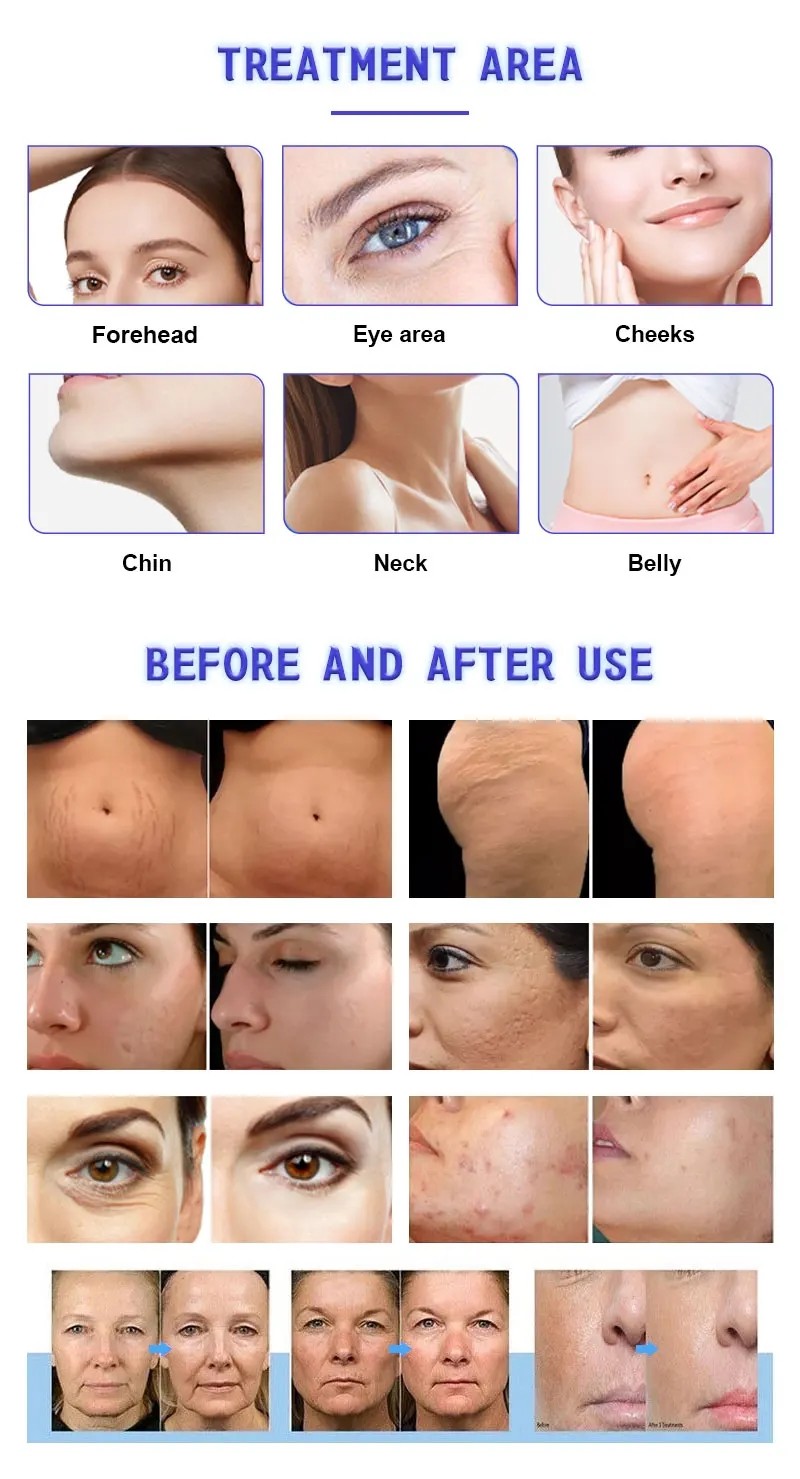 2024 Morpheus8 Radio Frequency Micro Needling Machine With Ice Hammer For Your Skin Scar Acne Scar Stretch Marks