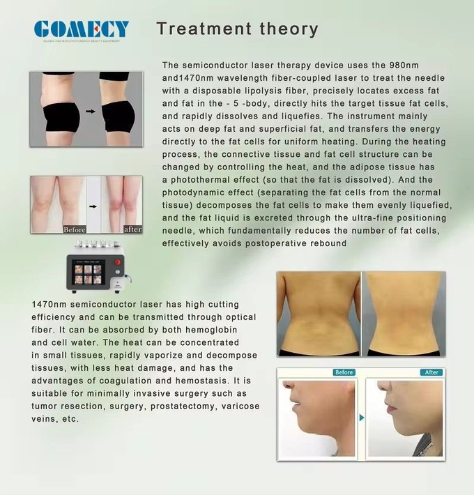 30W 1-10Hz Repetition Rate Endolift Laser Machine For Non Invasive Skin Tightening