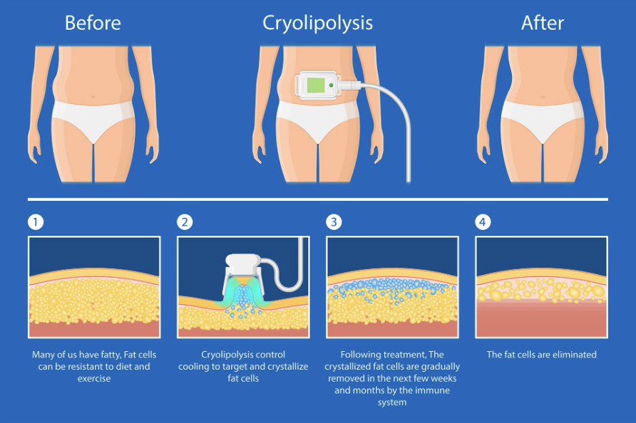 Lcd Cryolipolysis Slimming 650nm Portable Fat Freezing vacuum slimming Machine