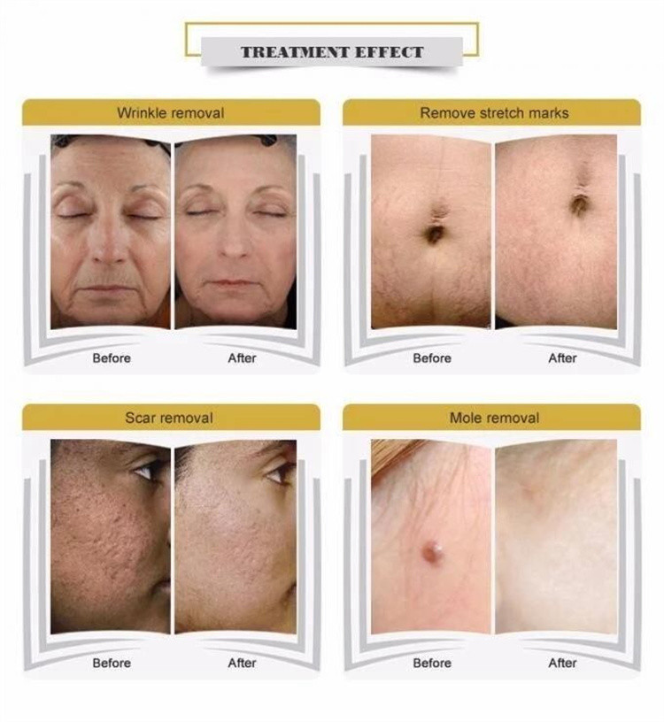 635nm CO2 Fractional Laser Machine For Melasma / Pigmentation Removal