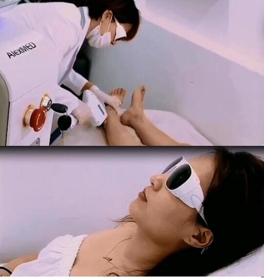 1Hz Beauty Salon Smart 808nm Diode Laser Hair Removal Machine