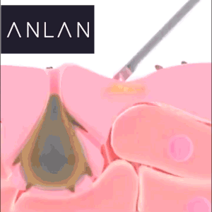 Remover blackhead