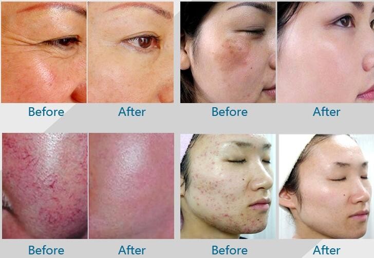 4 ColorLED Phototherapy Machine For Decrease Spider Veins / Broken Capillaries