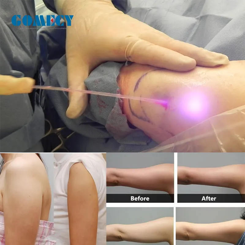 810 980 1064nm Laser Machine With Battery Class Iv 20w Pain Relief Laser Therapy Machine 980