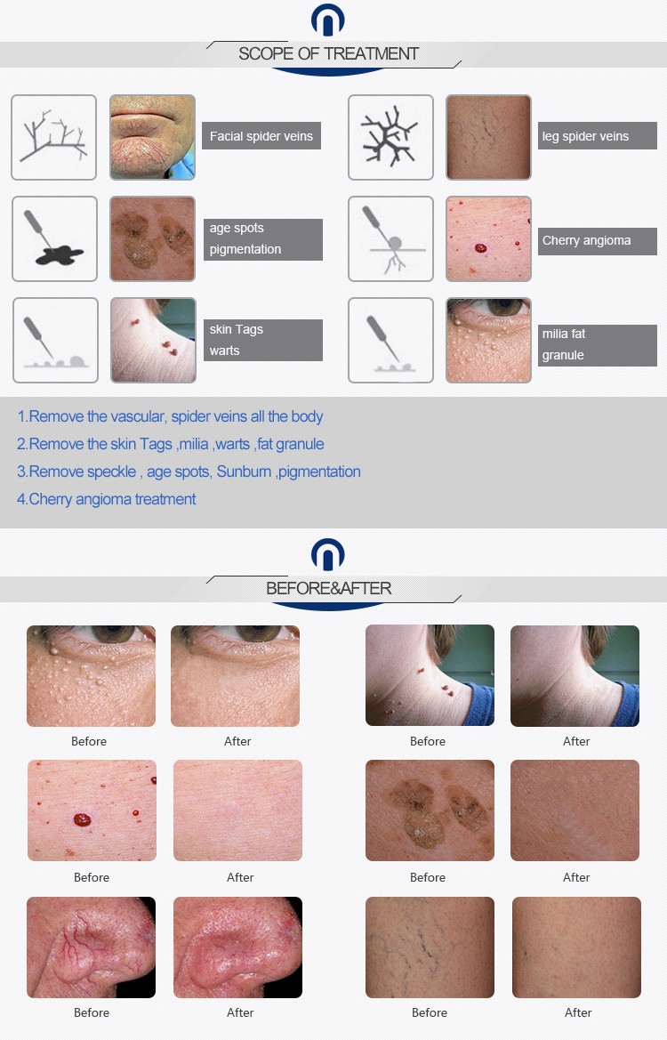 30MHz high frequency150W portable Laser Spider Vein Removal Machine