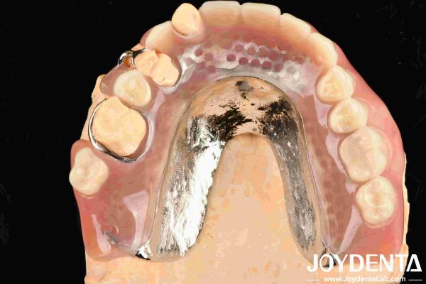 Beautiful And Harmonious Framework Set UP Teeth Finish For Dental Treatment