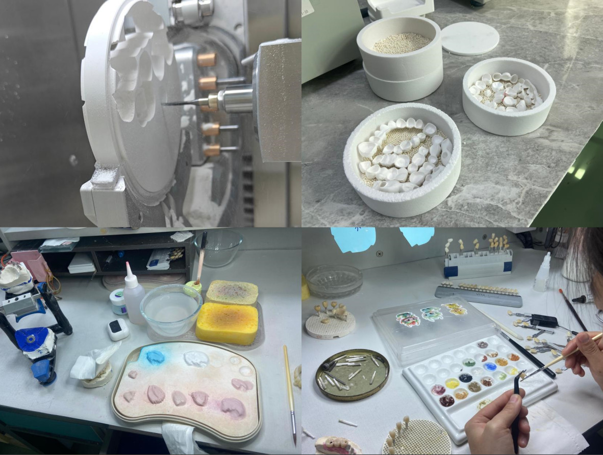 Translucencys IPS Emax Veneers , Minimal Preparation Emax Dental Veneers
