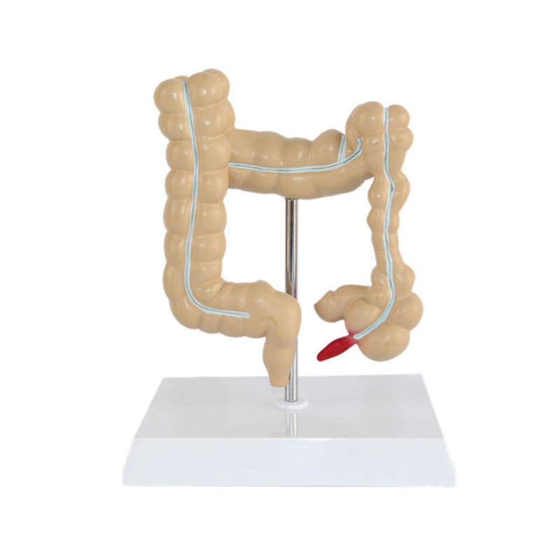 Colon Pathology 22.5cm Human Anatomy Model As Medical Teaching Learning Tool