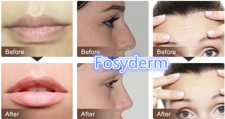 Skin Care Hyaluronic Acid Injectable Dermal Filler for Anti Wrinkle 2ml CE ISO