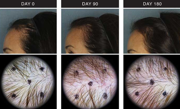5ml Youth Serum Injection Head Skin Care PRP Injection For Hair Growth