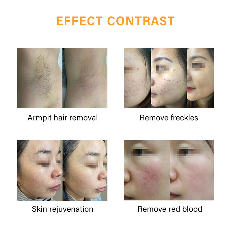 Skin Rejuvenation 1200W IPL Hair Removal Machine 530nm To 1200nm