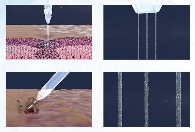Needle Free Injector Myjet Oxygen jetPeeling Skin For Under Eye Bags Fine Lines And Wrinkles Treatment