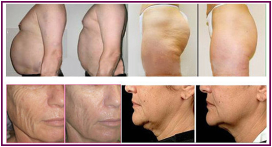 Portable Channeling Optimized RF Skin Tightening Machine For Home