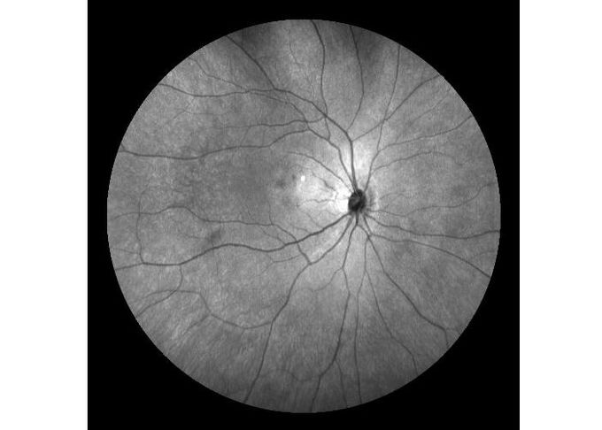 Ultra-wide Field Laser Scanning Retina Angiograph Digital Ophthalmic Equipment With Optical Zoom 100°/60°/30°