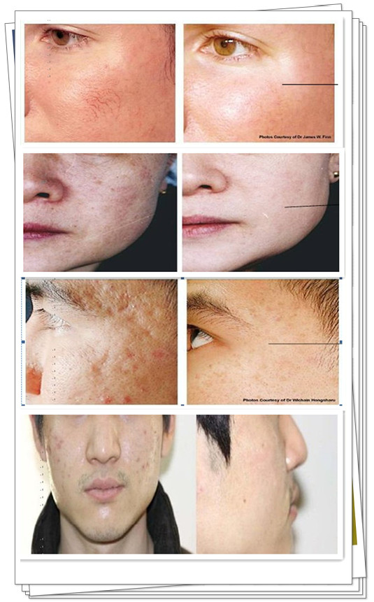 Professional fractional RF microneedle machine beauty salon equipment for face lifting