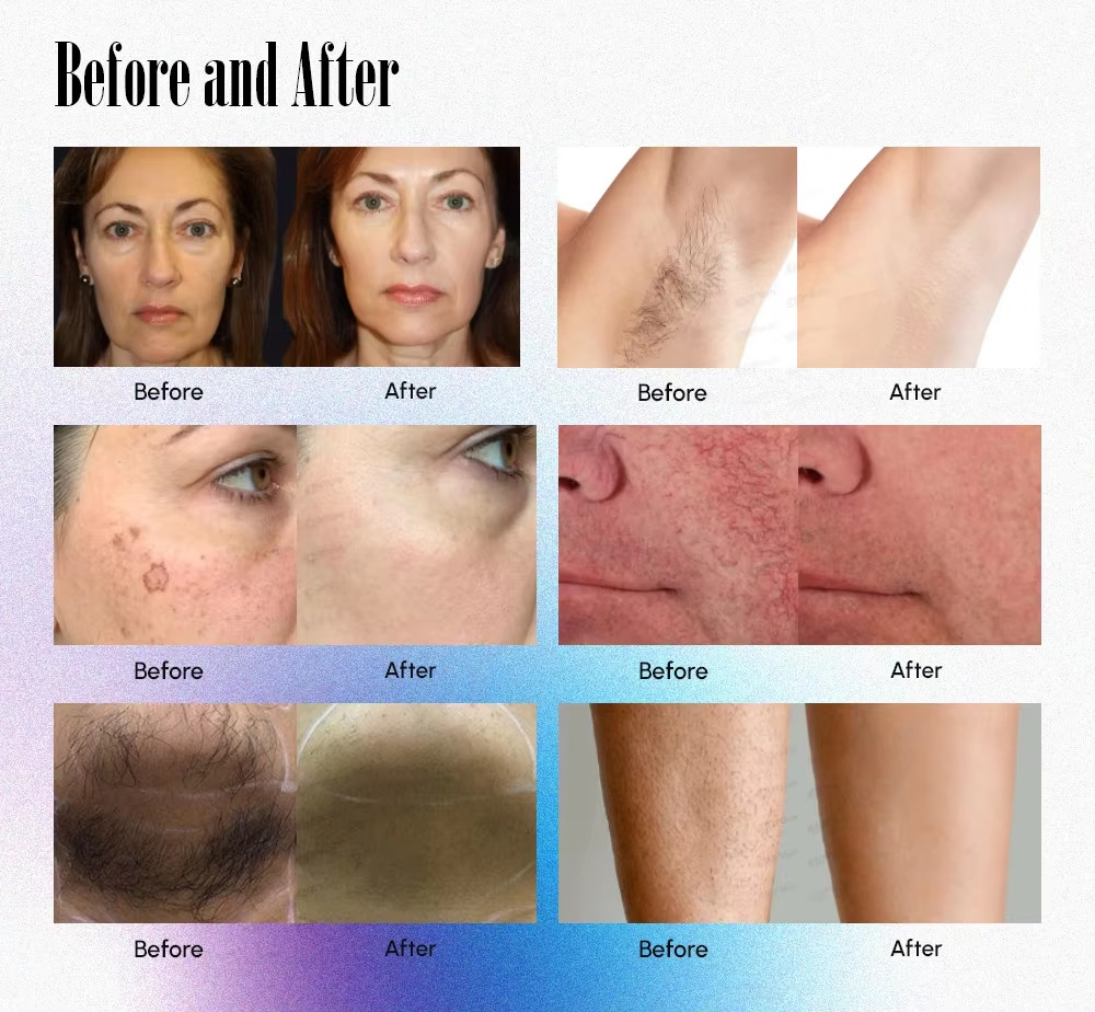 r Super Strong Hair Removal Alexandrite Beauty Machine Alex Laser755nm Alexandrite Laser 1064nm ND YAG Long Pulse Lase
