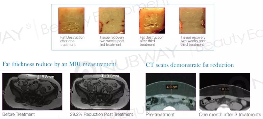Most Advanced Non-Invasive HIFU Cellulite Ultrasonic Slimming Machine