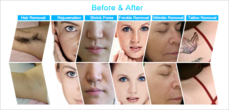 Hottest elight ipl rf nd yag laser multifunction beauty apparatus with CE