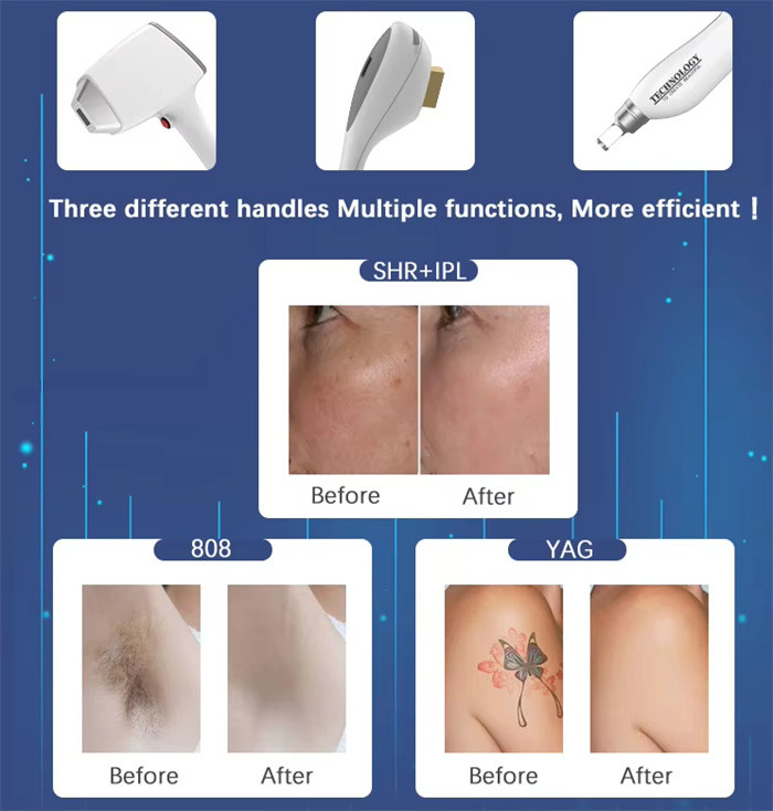 3 IN 1 Nd Yag 808nm Diode Laser Hair Tattoo Removal IPL Acne Treatment Machine