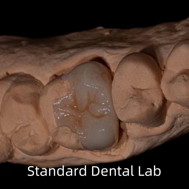 Translucency Emax Zirconia Dental Inlay Onlay Crown For Restore Natural Cavity Shape