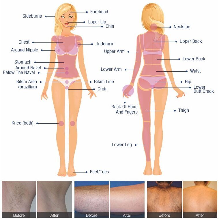 Epilator Clinical Diode Laser Hair Removal System Stationary Diode 808 Laser Machine