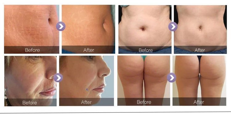 Abdomen 3 In 1 Vacuum Slimming Machine Liponix