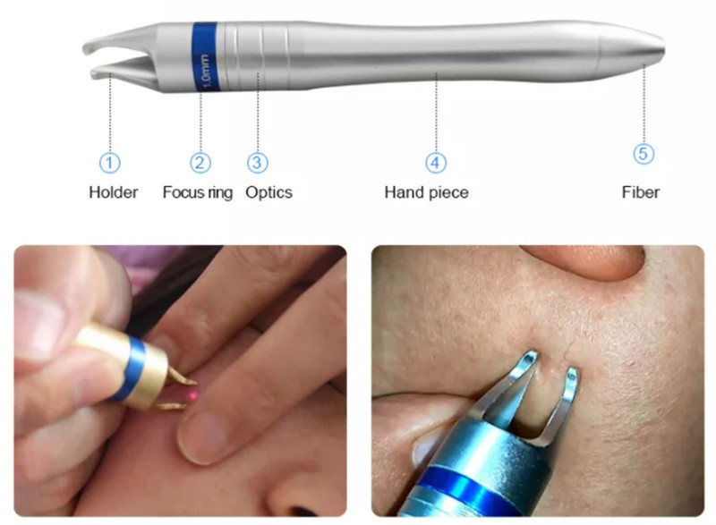 980nm Diode Laser Spider Vein Removal Machine Nail Fungus Treatment