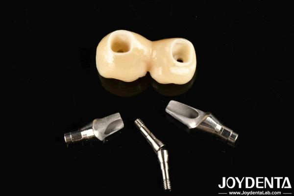 Experience Aesthetically Pleasing Results With Customizable Implant Retained