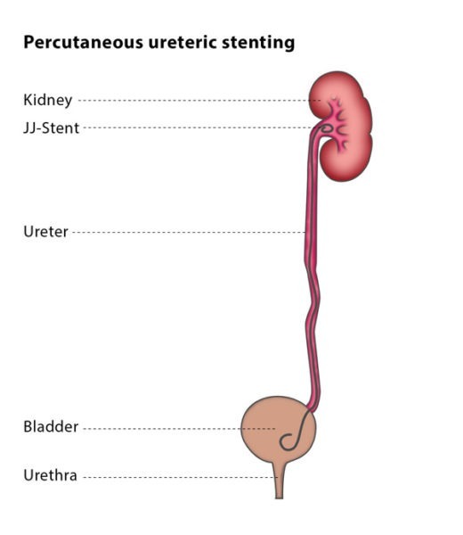 ISO13485 Disposable Double J Ureteral Stent 4.8Fr
