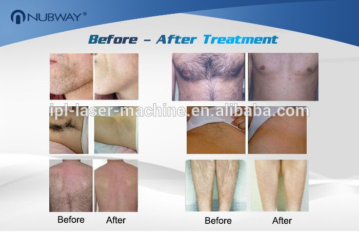 3 years warranty beauty equipment 808nm diode laser lightsheer laser hair removal machine for sale