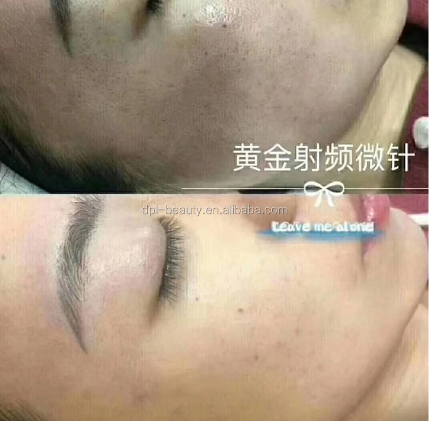 Wrinkle Removal RF Fractional Microneedling Machine Face Tightening With 25pins