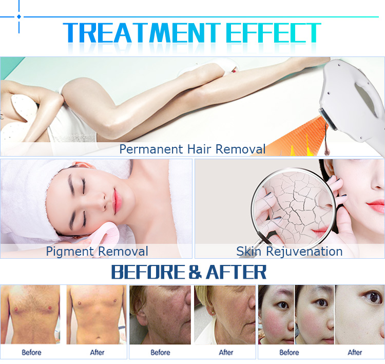 Europe hottest intense pulsed light hair removal skin rejuvenation machine machine ipl hair removal equipment