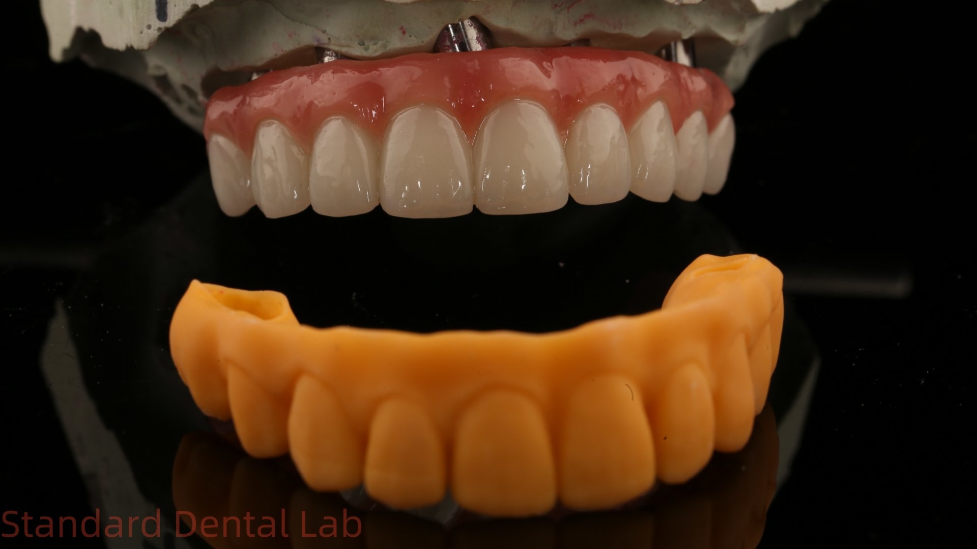 5 Year Guarantee Dental Implant Crown PMMA Bridge Over Multi Unit Abutments Customized Vita Shade