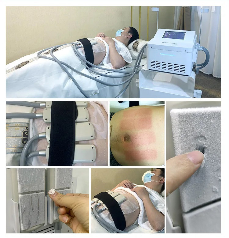 Portable Fat Freezing Machine Slimming Fat Cellulite Removal Cryotherapy Device Cryo Plates