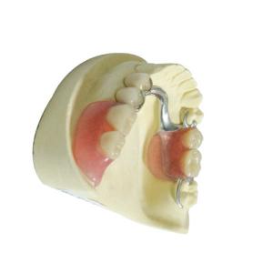 China Professional Dental Lab Products Acrylic Removable Partial Dentures on sale