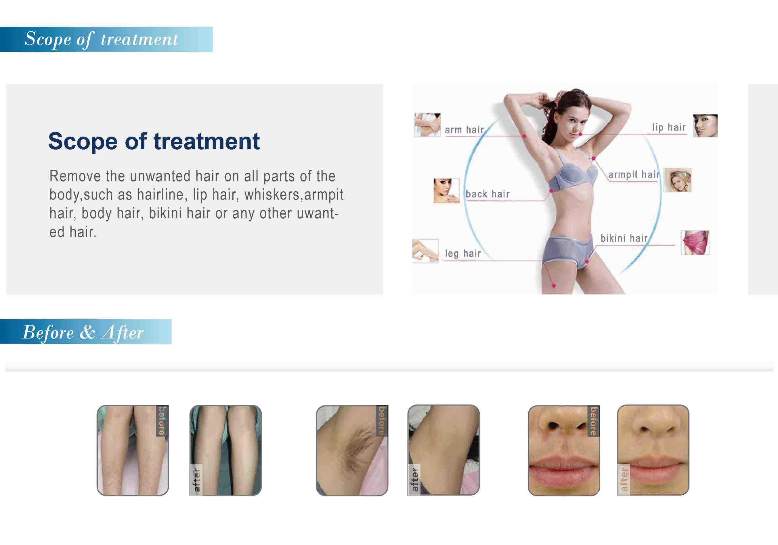 Salon equipment laser hair removal fda approved laser hair removal machine