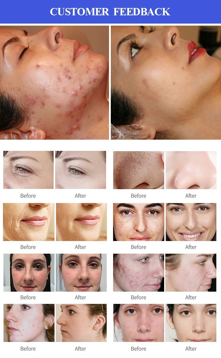 China Beauty Oxygen Facial Machine Water Diamond Hydra Dermabrasion Device Manufactuer