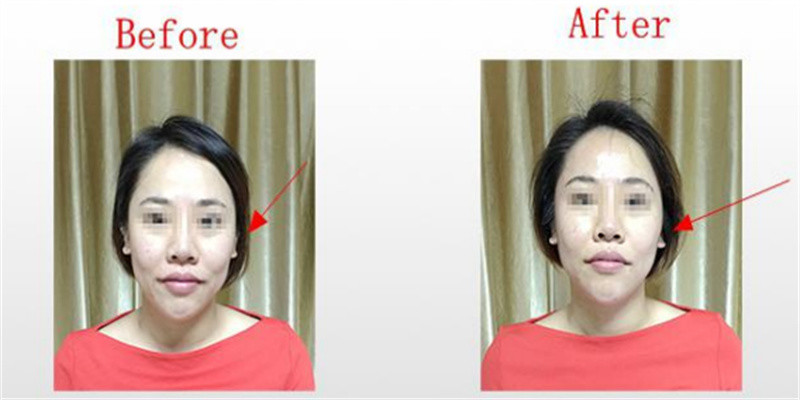 Vacuum Focus Rf Thermolift Face Lifting Machine / Device Wrinkle Removal