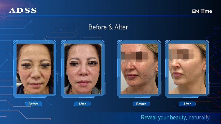 ODM EMtime RF Wrinkle Removal Face Lifting Tighten Slim Face Machine For Salon