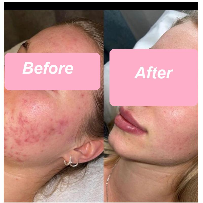 Ipl Permanent Hair Removal Ipl Skin Rejuvenation Hair Removal Freckles Removing Device