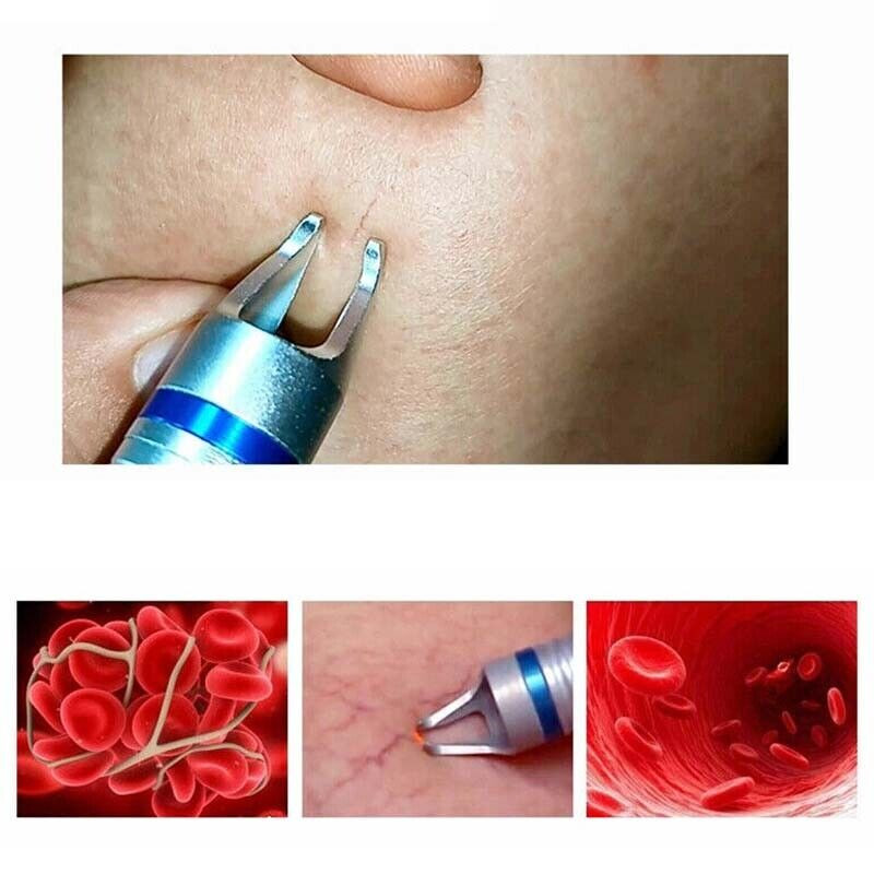 Professional 30W Laser Beauty Machine 980nm Diode Laser Spider Vascular Vein Removal