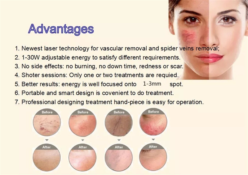 980nm Diode Laser Spider Vein Removal Machine Nail Fungus Treatment