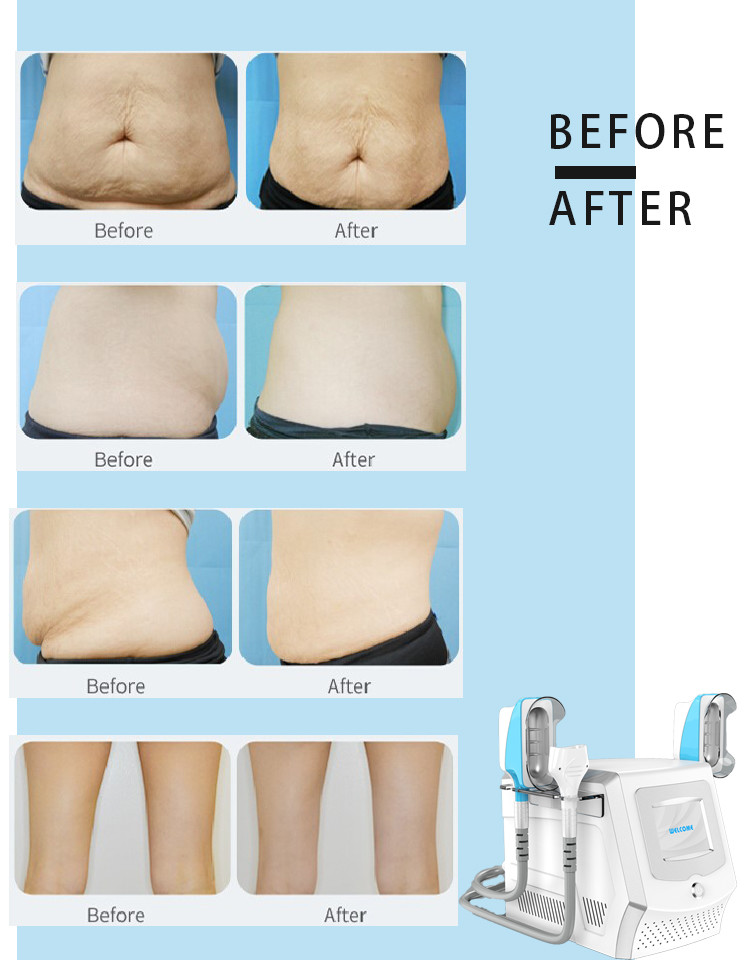 LAFO design Double Chin 360 cryo machine/cryolipolysis machine 360/fat slimming machine cryotherapy