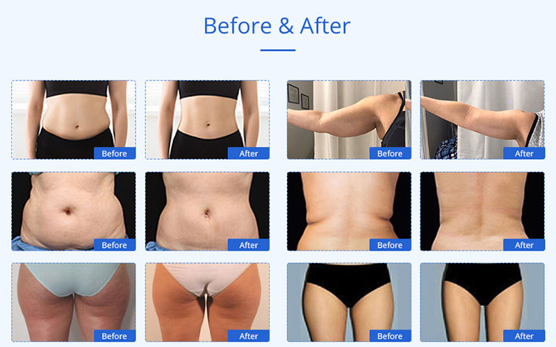 cavitation