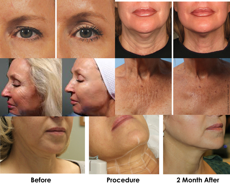 hot sale hifu for wrinkle removal system face lift muscle tone machine