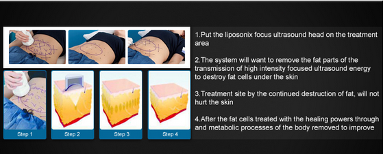 2016 Newest Model Ultrashape / Liposonix / HIFU Slimming Machine With Good Quality