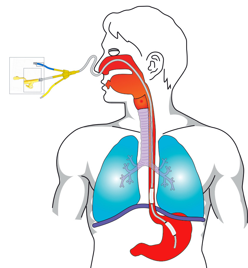 Enteral feeding tube with two balloons for esophageal and gastric pressure measurement medical equipment