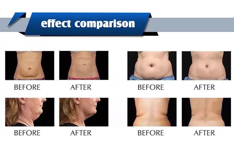 AS81 Cellulite Reduction Rf Cavitation Vacuum Device , 3D Vacuum Body Shaper Machine