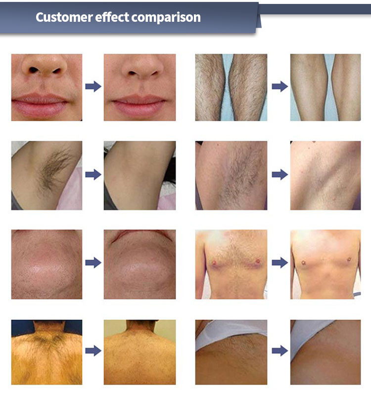 Efficient Diode Laser Hair Removal Machine with AC110V/60Hz Power Supply