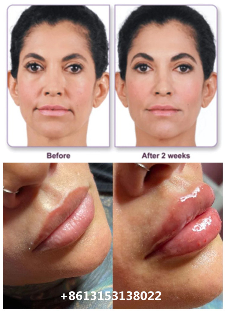 Juvederm Voluma Injectable Hyaluronic Acid Dermal Filler 2x1ml